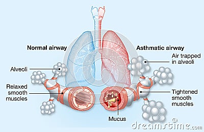 Asthma, normal and asthmatic airways, medically illustration Cartoon Illustration