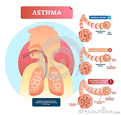 Asthma vector illustration. Disease with breathing problems diagram.. Vector Illustration