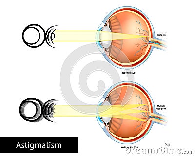 Astigmatic Eye and Normal Eye. Astigmatism, refractive or refraction error. Multiple Focal point. Vector Illustration