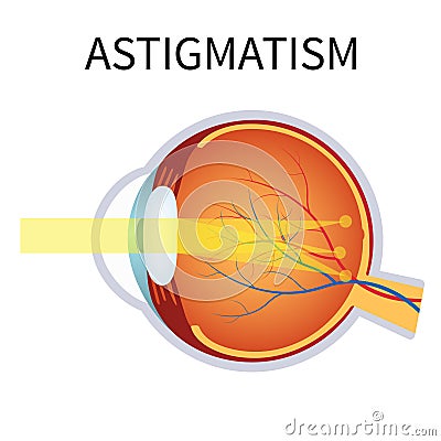 Astigmatism. Eyesight problem, blurred vision. Vector Illustration