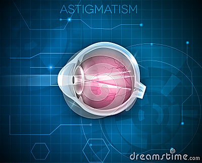 Astigmatism, eyesight problem Vector Illustration