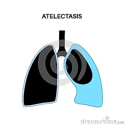 Atelectasis medical poster Vector Illustration