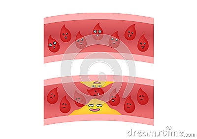 Atherosclerosis anime icon vector / fat stuck in the blood artery cholesterol Vector Illustration