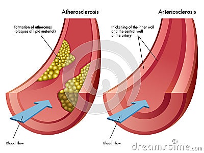 Atherosclerosis & Arteriosclerosis Vector Illustration