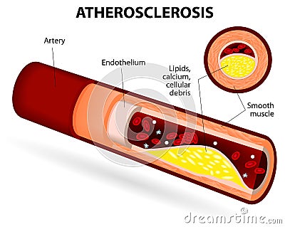 Atherosclerosis Vector Illustration