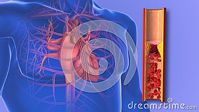 Atherosclerosis or clogged arteries in the human heart Stock Photo