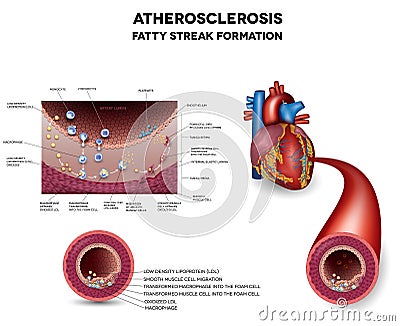 Atherosclerosis. Early stage Vector Illustration