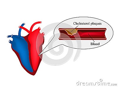 Atherosclerosis of the heart. angina pectoris. Heart disease. World Heart Day. Vector illustration on isolated background. Vector Illustration