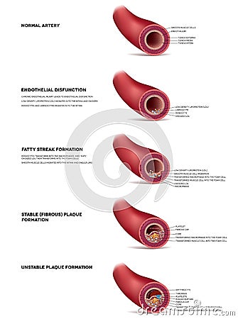 Atherosclerosis illustration Vector Illustration