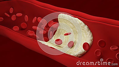 Atherosclerosis. Red blood cells. Cartoon Illustration