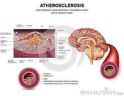 Atherosclerosis. Stable plaque formation Vector Illustration