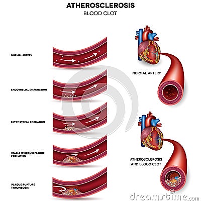 Atherosclerosis stages Vector Illustration
