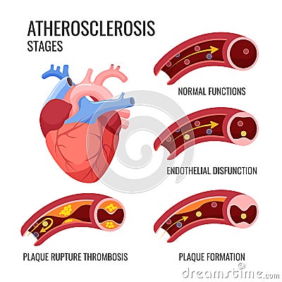 Atherosclerosis stages. Normal functions, endothelia disfunction, plaque formation, rupture thrombosis Vector Illustration