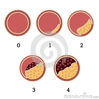 Atherosclerosis stages 1 Vector Illustration