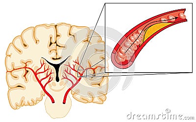 Atherosclerosis and stroke Vector Illustration
