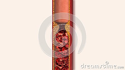 Atherosclerotic cardiovascular disease and stroke Stock Photo