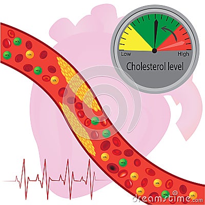 Atherosclerotic plaque in blood vessel, good and bad lipids Vector Illustration