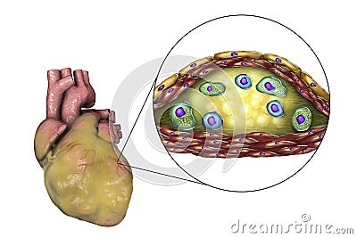 Atherosclerotic plaque in coronary blood vessel of obese heart, illustration Cartoon Illustration