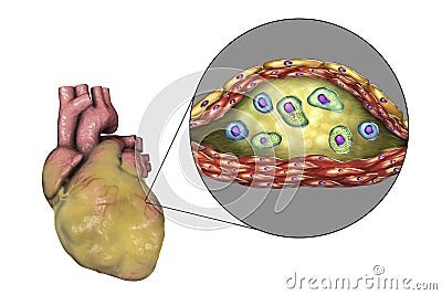 Atherosclerotic plaque in coronary blood vessel of obese heart, illustration Cartoon Illustration