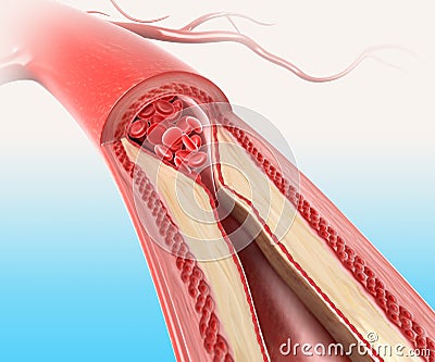 Athersclerosis in artery Cartoon Illustration