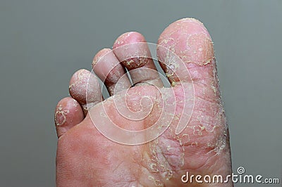 Athlete`s foot - tinea pedis, fungal infection Stock Photo