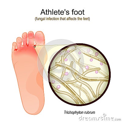 Athletes foot. Close-up of Trichophyton rubrum Vector Illustration