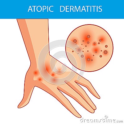Atopic dermatis. The person scratches the arm on which is atopic dermatitis. Itching. Vector Illustration
