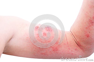 Atopic dermatitis AD, also known as atopic eczema, is a type of inflammation of the skin dermatitis at foot. Stock Photo