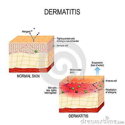 Atopic dermatitis eczema Vector Illustration