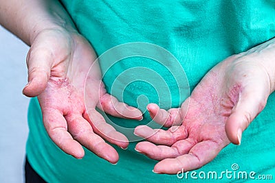 Atopic dermatitis, The woman looks at red and chapped hands with severe allergies Stock Photo