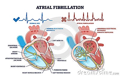 Atrial fibrillation as abnormal heart beat frequency disease outline diagram Vector Illustration