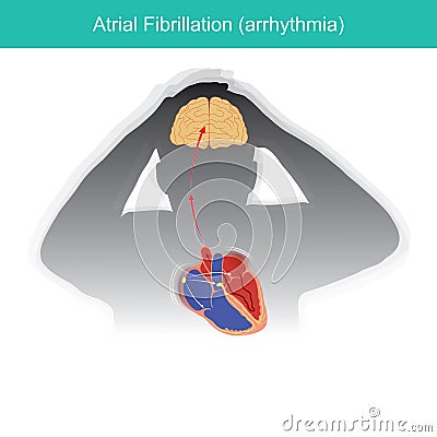Atrial Fibrillation. Patients condition in which the electrical signals in heart malfunctioning or causing a short circuit in Vector Illustration