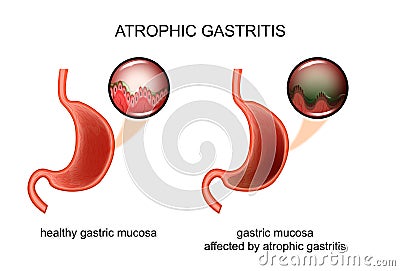 Atrophic gastritis. inflammation Vector Illustration