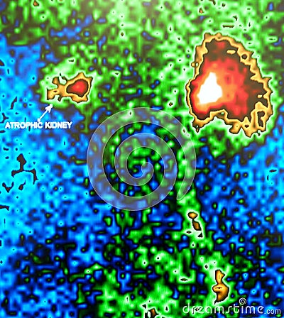 Atrophic kidney nuclear medicine Stock Photo