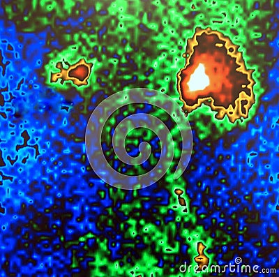 Atrophic kidney nuclear scan Stock Photo