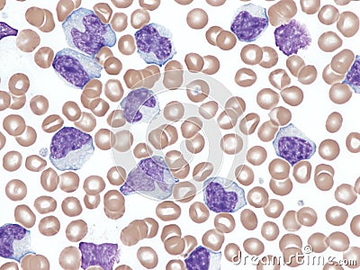 Atypical chronic lymphocytic leukemia in peripheral blood. Stock Photo