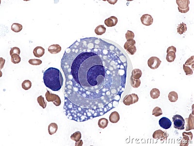 Atypical megakaryocyte in a case of myelodysplastic syndrome. Stock Photo