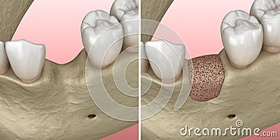 Augmentation Surgery - Adding new bone. illustration Cartoon Illustration