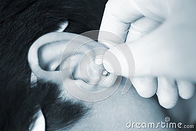 Auriculartherapy ear seed treatment Stock Photo