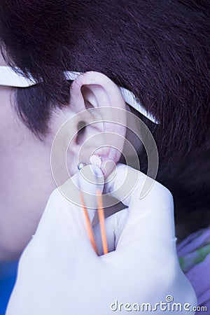 Auriculartherapy ear seed treatment Stock Photo