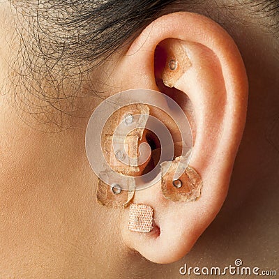 Auriculotherapy on human ear. Stock Photo