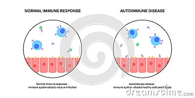 Autoimmune hepatitis disease Vector Illustration