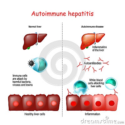 Autoimmune hepatitis Vector Illustration