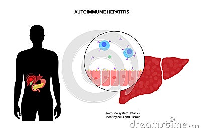 Autoimmune hepatitis disease Vector Illustration