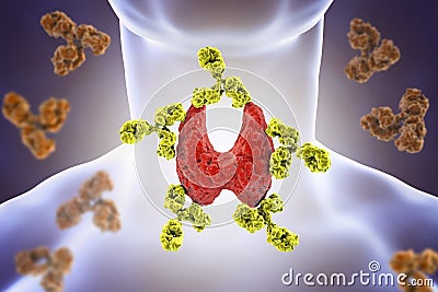 Autoimmune thyroiditis, Hashimoto`s disease Cartoon Illustration