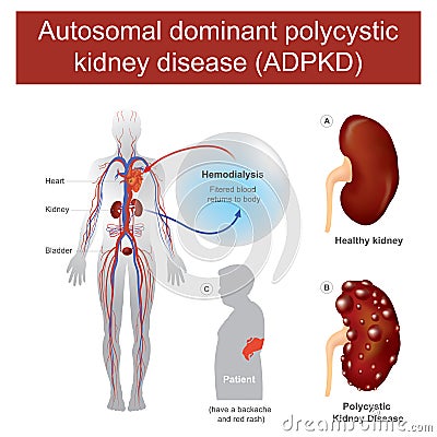 Autosomal dominant polycystic kidney disease. Stock Photo