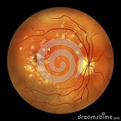 Autosomal recessive bestrophinopathy, ophthalmoscope view, scientific illustration showing accumulation of lipofuscin Cartoon Illustration