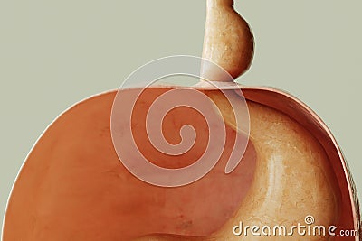 Axial hiatus hernia type 1 - entrance to the stomach via the diaphragm - 3D rendering Stock Photo