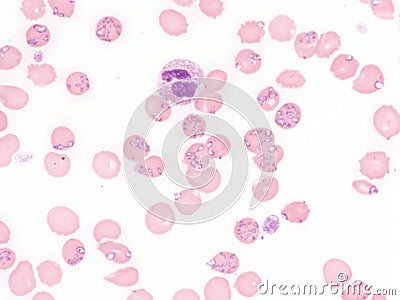 Babesiosis in peripheral blood. Stock Photo