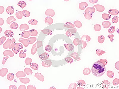 Babesiosis in peripheral blood. Stock Photo